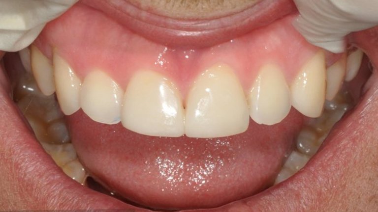 Composite Veneers - A
