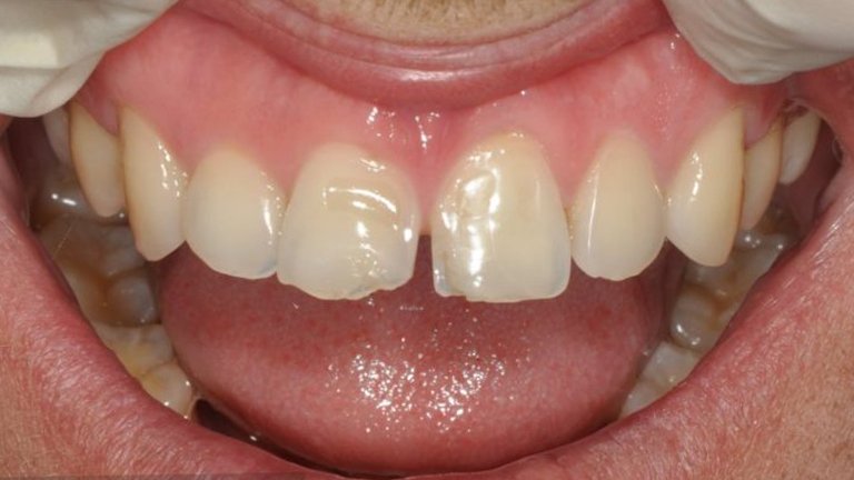 Composite Veneers - B
