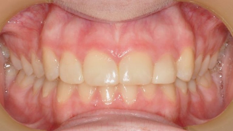 Composite Veneers - Gap Closure A
