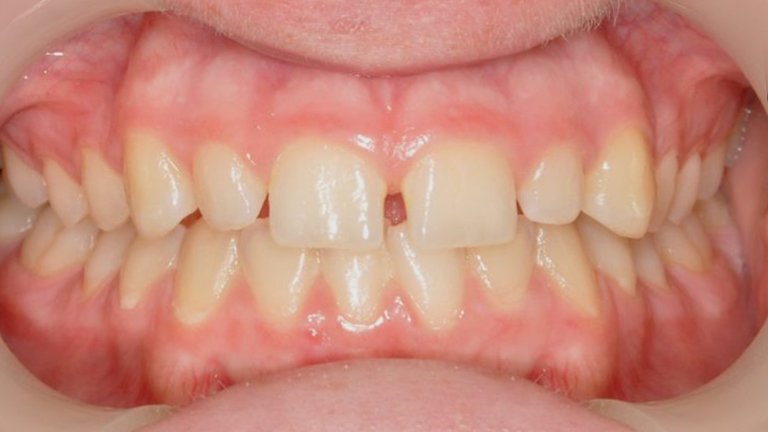 Composite Veneers - Gap Closure B