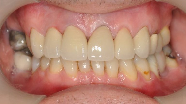 Crown Replacement - After