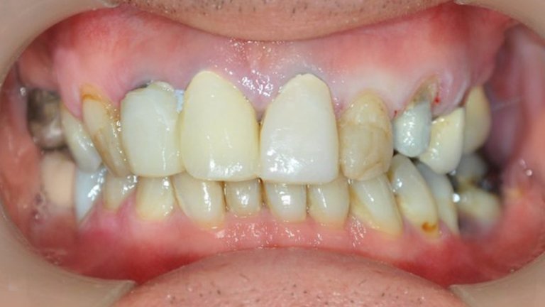 Crown Replacement - Before