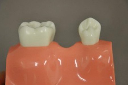 Dental Bridges - 2