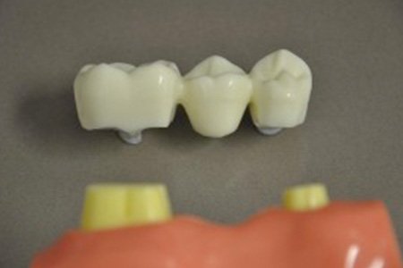 Dental Bridges - 4