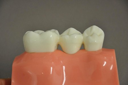 Dental Bridges - Main