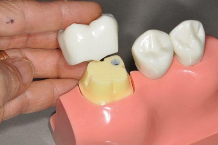 Dental Crowns - 2