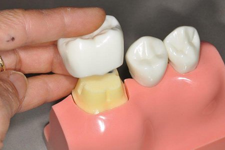Dental Crowns - 3