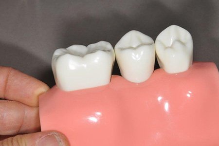 Dental Crowns - 4