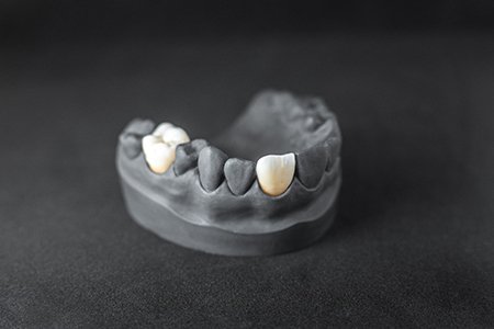 Dental Crowns