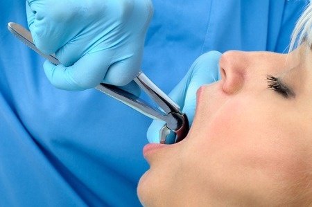 Dental Extractions