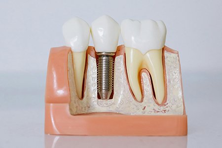 Dental Implant_