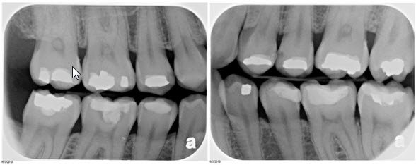 Intra-Oral-X-Ray