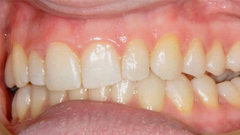 Invisalign - After