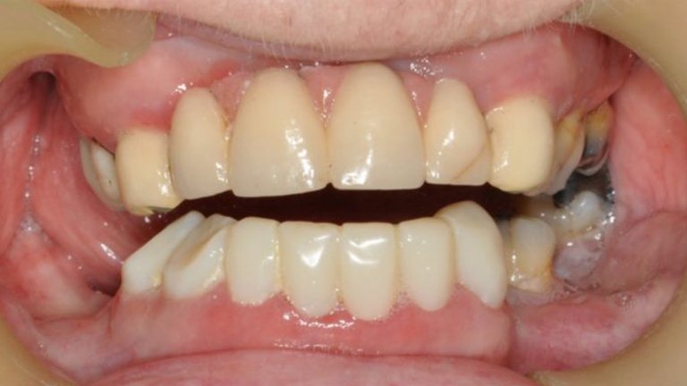Reconstruction of Lower Teeth - After