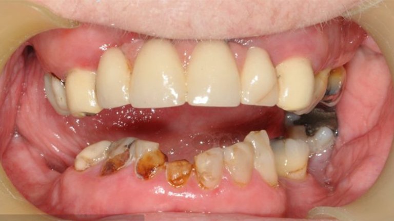 Reconstruction of Lower Teeth - Before