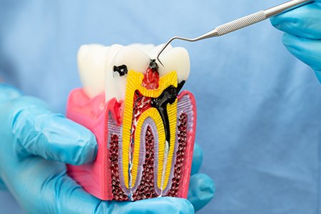 Root Canal Treatment