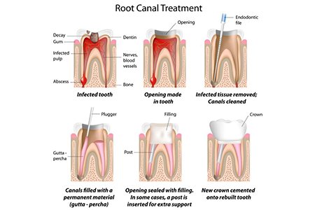 Root Canal Treatment