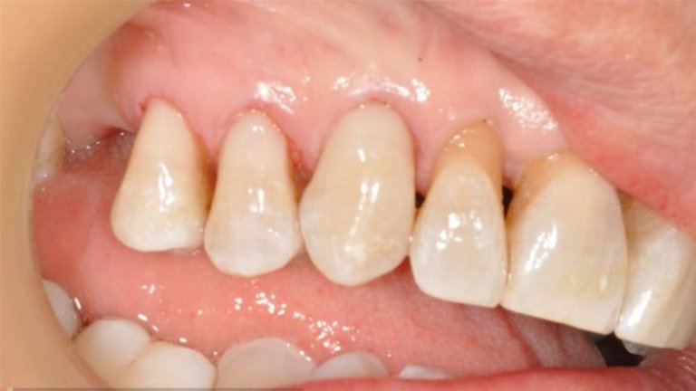 Tooth Brush Abrasion - After