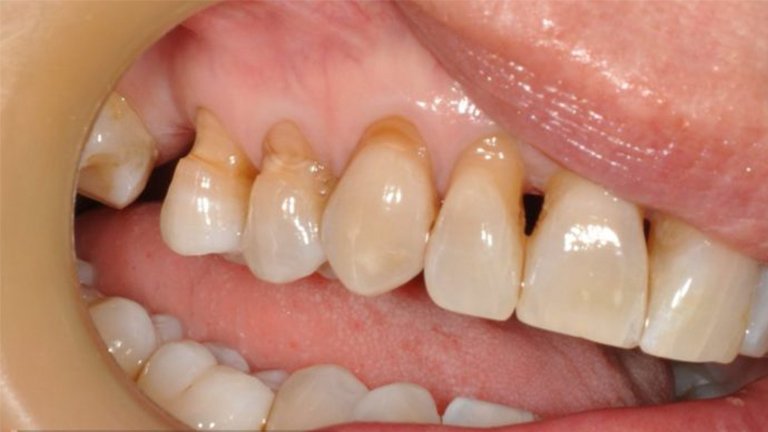 Tooth Brush Abrasion - Before