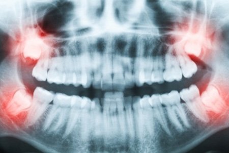 Wisdom Teeth Removal